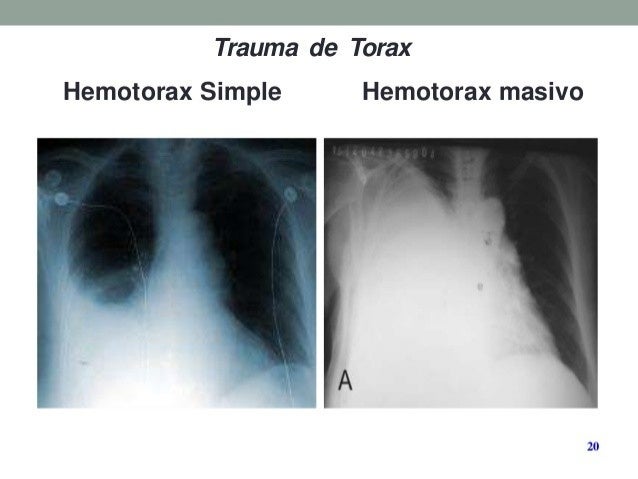 hemotorax masivo